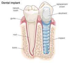 Graphic of a dental implant